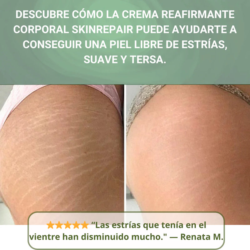 SKIN REPAIR ™| Elimina Tus Estrías en 3 Semanas